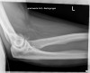 SPORK, NICO - 22.03.1976 - 02.08.2022 - Rö Ellenbogen links - 16:31:21 - ELBOW